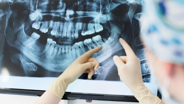 dentists with blue gloves on pointing at a digital dental x ray on screen