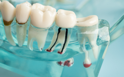 Do You Really Need a Root Canal? 7 Signs You Shouldn’t Ignore