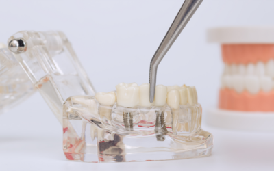 Dental Implants vs. Dentures: Which Option Gives You Better Long-Term Function?