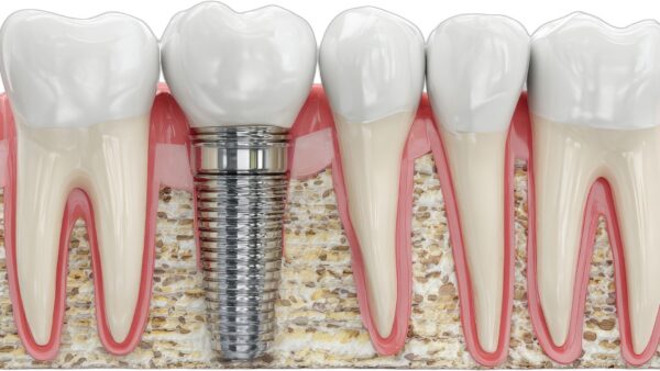 dental implant graphic with other teeth in jaw