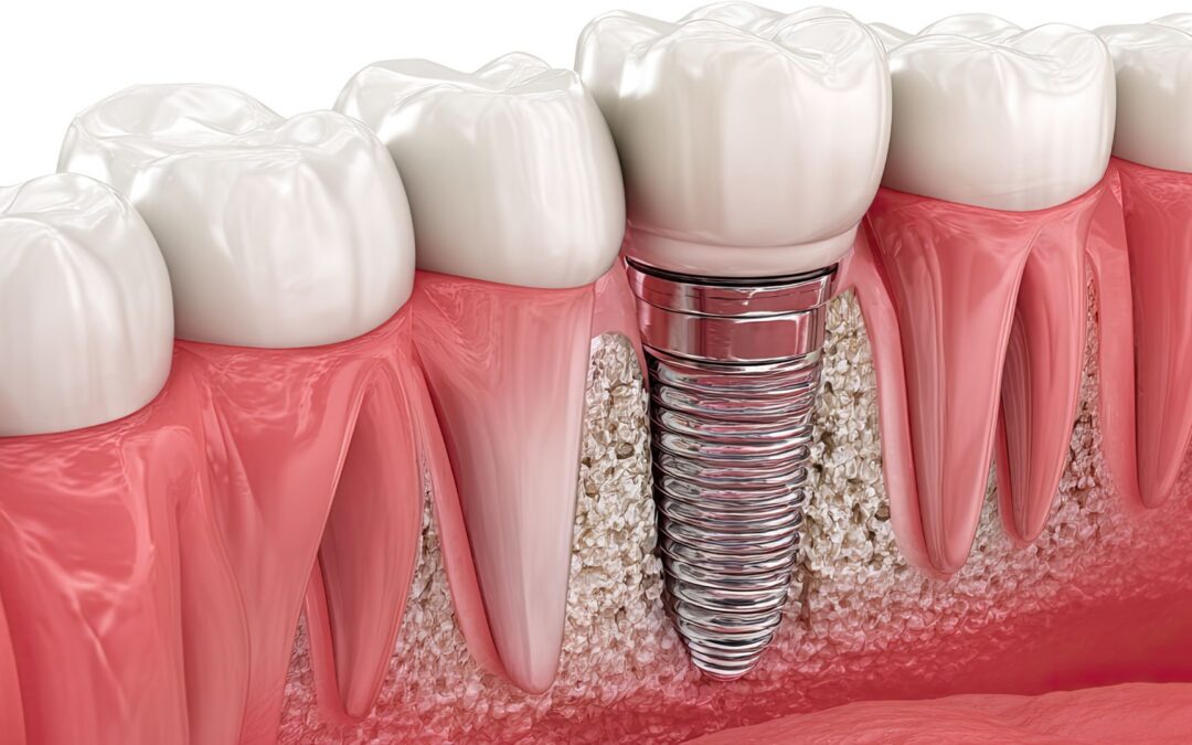dental implant in jaw