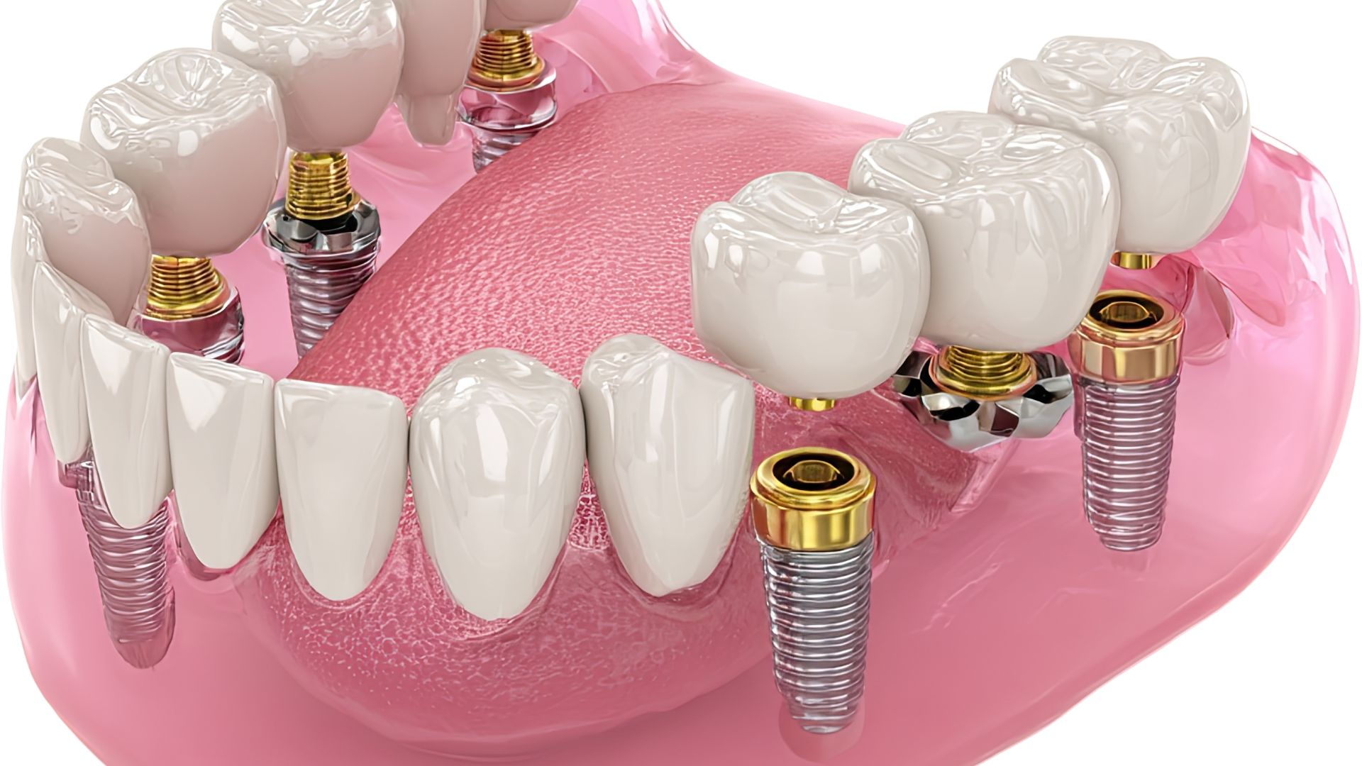 dental implant visual explained 