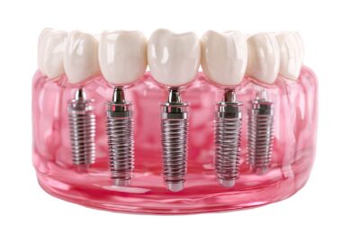 Questions To Ask Before Choosing An Implant Dentist