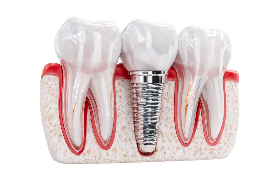 dental implants in jaw