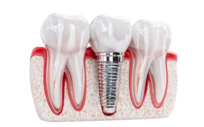 Am I A Good Candidate For Dental Implants? What Parkway Dental Patients Ask Most