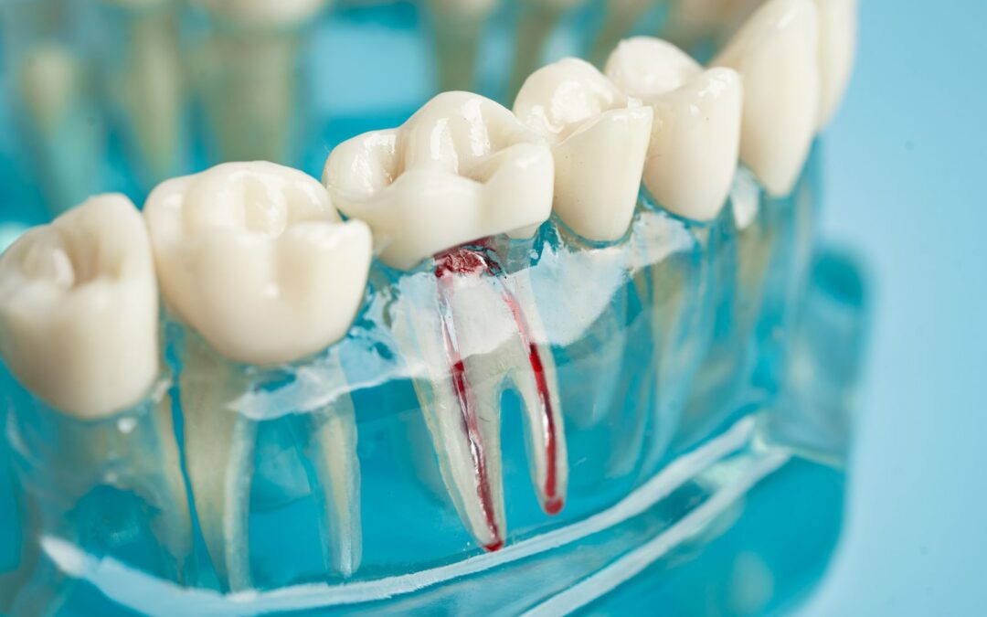Close-up of a dental model showing molars in a blue base, with red markings along the tooth roots suggesting a procedure
