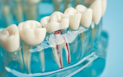 What Happens If You Need A Root Canal And Don’t Get One